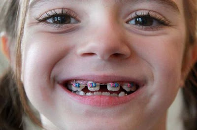 Niềng răng trẻ em bằng loại mắc cài nào?