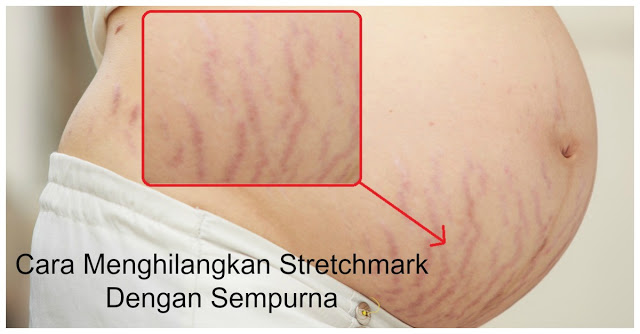 Bekas Stretchmark Setelah Melahirkan ini Ternyata Bisa di Hilangkan Loh Bund ! Ikuti CARA Briliant Berikut Ini !!