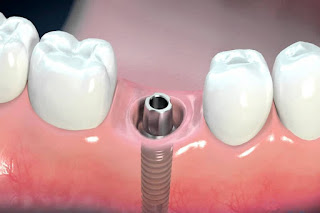 Lưu ý khi trồng răng implant-3