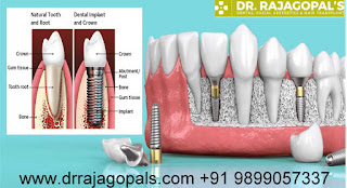 Dental Implant Treatment in Gurgaon