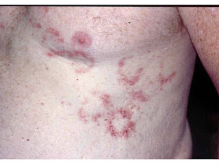 Consultations in Dermatology: The Groin Cracks Hailey Hailey Disease