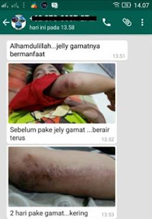 Cara Menyembuhkan Cantengan Yang Sudah Parah Dan Tidak Kunjung Sembuh