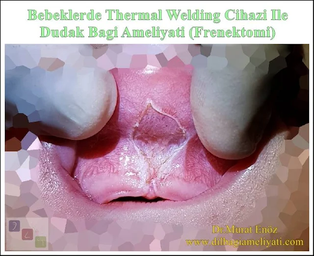 Bebeklerde Thermal Welding Cihazı İle Üst Dudak Bağı Ameliyatı (Frenektomi)