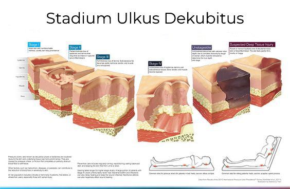 Ulkus Dekubitus Stage or Level