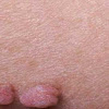 Nama Obat Daging Tumbuh Pada Kelamin