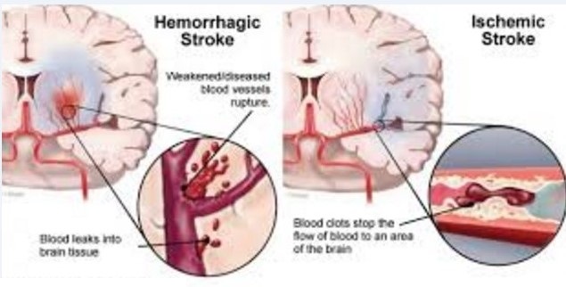 Apa itu stroke ? Bagaimana Mengatasinya - Smart Detox Synergy