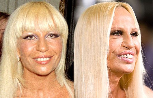 Donatella Versace Before and After Plastic Surgery