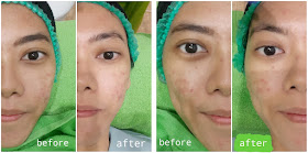 Before - After ZAP Photo Facial Acne