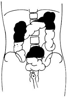 Barium Enema