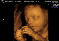 3d Sonogram3