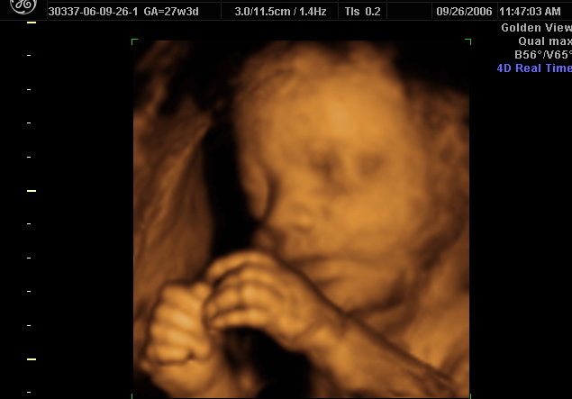 3d Sonogram3