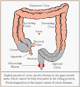 This explanation would suggest that colon cancer is related to constipation.