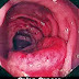 El cáncer colorrectal ( analgésico ) y Relación entre la energía y la experiencia y del pensamiento
