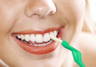 Chải răng sau khi niềng răng 