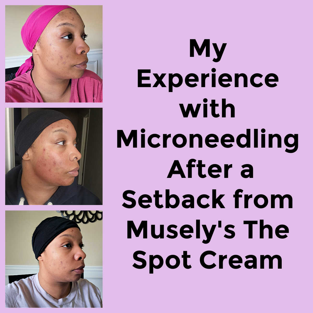 My Experience with Microneedling After a Setback from Musely's The Spot Cream