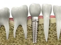 cost of tooth implant,tooth implant cost,how much does a tooth implant cost,cost of dental implants