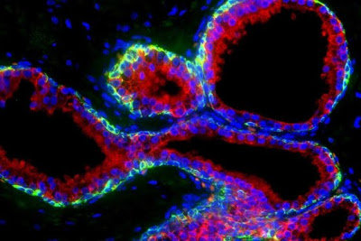 El origen del cáncer de próstata, en las células equivocadas