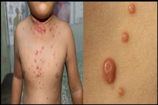 gejala penyakit molluscum contagiosum