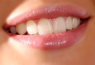 răng sứ có tuổi thọ khoảng bao lâu