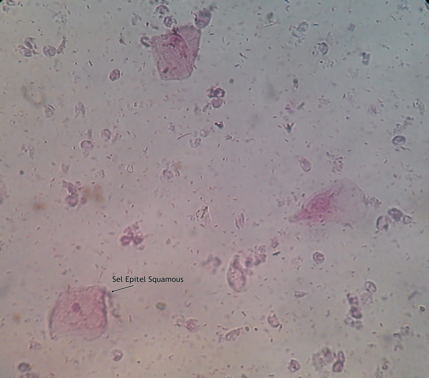 Sedimen Urine (Stainning)  Analis Kesehatan