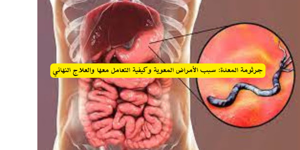 جرثومة المعدة: سبب الأمراض المعوية وكيفية التعامل معها والعلاج النهائي