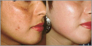 comment éliminer les cicatrices d'acné