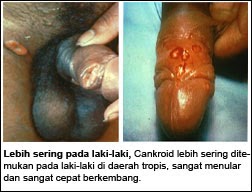 cara mencegah sakit sipilis, antibiotik untuk mengobati sifilis, artikel bakteri penyebab penyakit sifilis