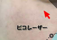 【シミ治療】ピコレーザー/ピコトリプル施術10日後