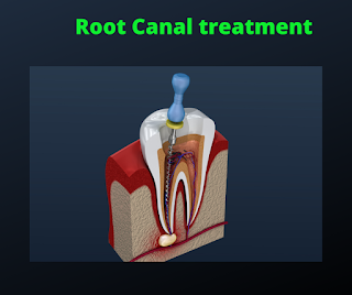 Root Canal treatment