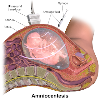   culdocentesis, culdocentesis positive result, culdocentesis definicion, culdocentesis non-clotting blood, culdocentesis procedure, culdocentesis procedure video, culdocentesis pronunciation, posterior colpotomy, angiography prep