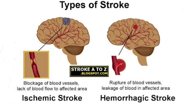 Jenis-jenis Penyakit Stroke