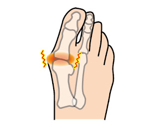 外反母趾になり、足の親指（母趾）の付け根付近の関節周辺が炎症し、関節炎や関節痛を起こしている状態を表しているイラスト