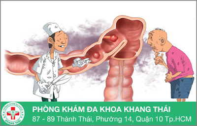 Điều trị polyp hậu môn bằng cách nào tốt nhất