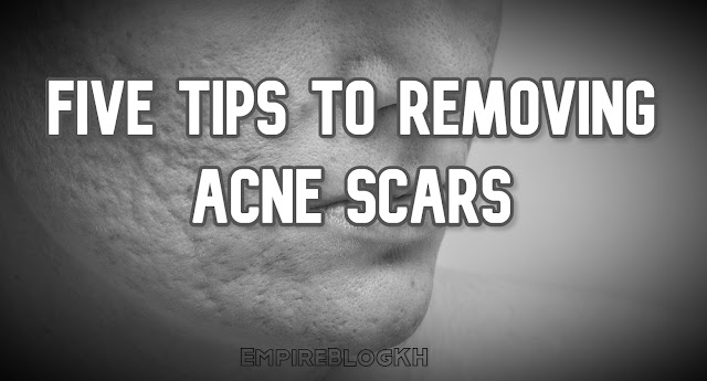 Five Tips To Removing Acne Scars