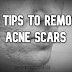 Five Tips To Removing Acne Scars