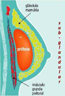 implante sub-glandular