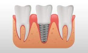 dental implants