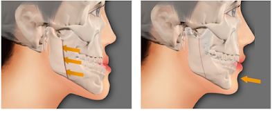 Điều trị móm do xương hàm