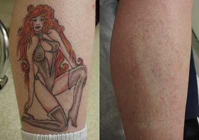 Tatto Removal Laser on L  Hett  Nyt Tattoomaniac Klo 0 34