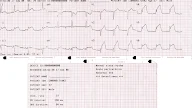 What Does A Abnormal Ekg Look Like - It means your ecg was abnormal.