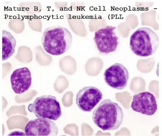 Mature B, T, and NK Cell Neoplasms - Prolymphocytic leukemia (PLL)