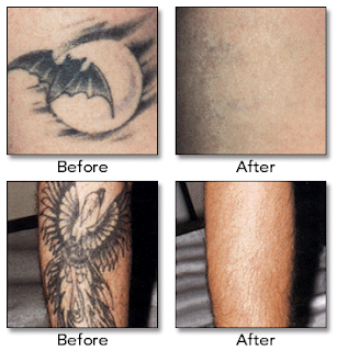Tattoo Removal- Side Effects
