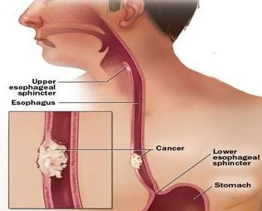 Signs of esophageal cancer treatment.