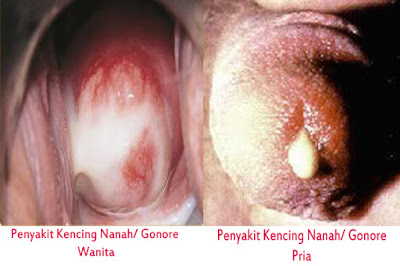 Obat Kencing Nanah Dari Dokter