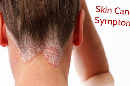 Symptoms Of Melanoma Skin Cancer