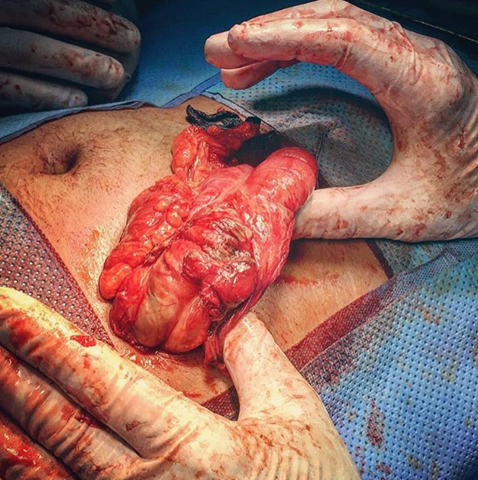 This appendectomy surgery was done for a complicated appendicitis. 