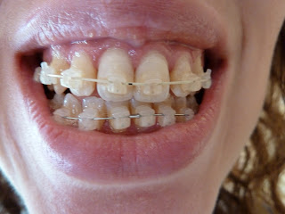 A photograph of teeth with fixed ceramic braces at week 17 of treatment