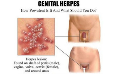 Luka Herpes Genital