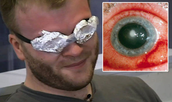 'My eyeballs were in flames' Teacher feared blindness as he fell ASLEEP with contacts in