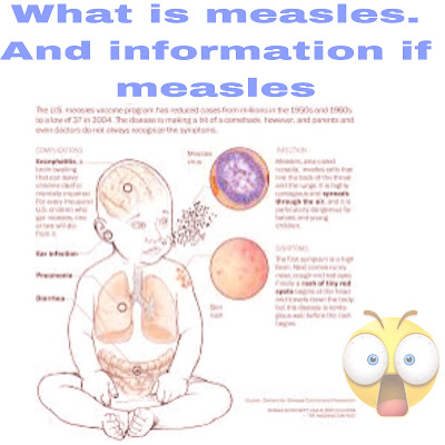 What is measles. And measles information.?